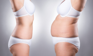 liposukcja to usuwanie tkanki tłuszczowej