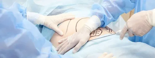 procedura liposukcji